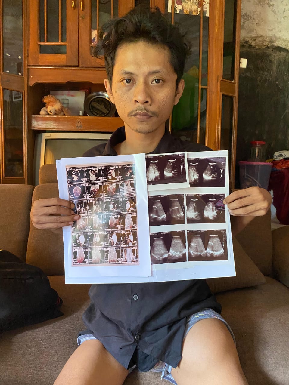 Nana Sudiana, Muallaf penderita Myxoid Liposarcoma sebuah kanker langka yang berasal dari jaringan lemak. (Foto: dokm ist/k1)